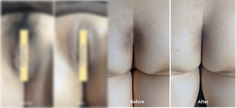 フェムケアマシン導入事例　ビフォーアフター写真